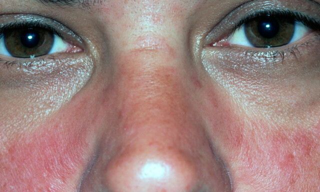 image: Lupus (SLE)